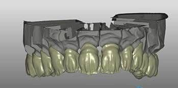 Digital design of a full set of upper crowns on screen