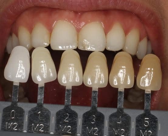Shade guide tabs held under a patient's upper front teeth to match the colour