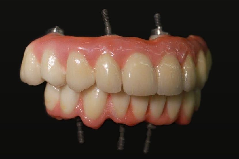 Upper and lower full-arch implant bridges made in our lab, shown on their implant screws
