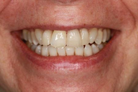 Patient 1 after treatment, upper left front tooth replaced with an implant crown, teeth and lips only