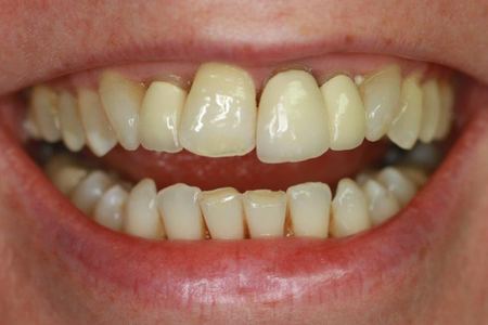 Patient 1 before treatment, teeth and lips only