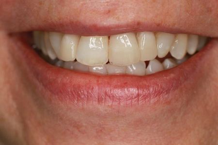 Patient 1 after treatment, upper left front tooth replaced with an implant crown, teeth and lips only