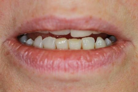 Patient 1 before treatment, teeth and lips only
