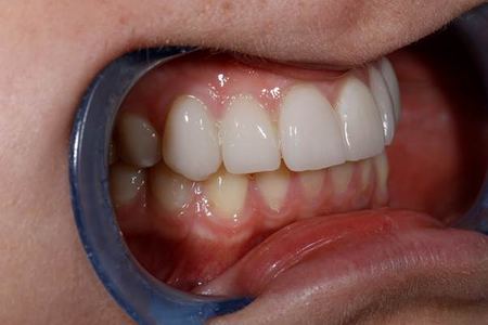Patient 2 after treatment, teeth and lips only