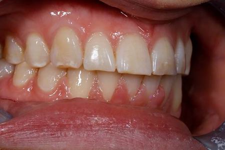 Patient 2 before treatment, teeth and lips only