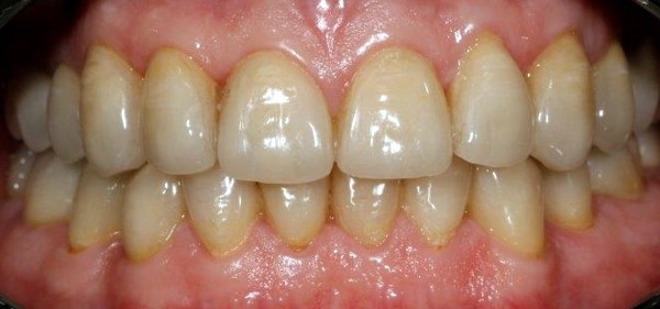 After: all teeth crowned in feldspathic porcelain made in our lab, teeth and gums only