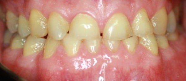 Before: worn and chipped natural teeth, teeth and gums only