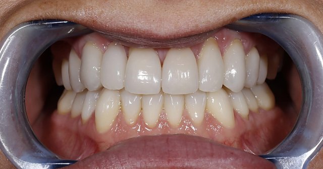 After: full upper and lower restoration with natural shape and texture, teeth and lips only