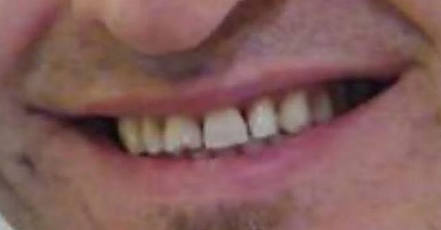 Before: worn, uneven front teeth, teeth and lips only