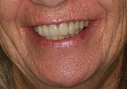 The same patient smiling after treatment, lower face only