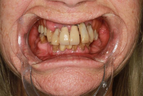 Patient’s teeth before treatment, lower face only