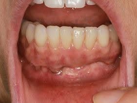 Lower All-on-4 implant bridge fitted in the mouth, gum-coloured porcelain blending into the natural gum