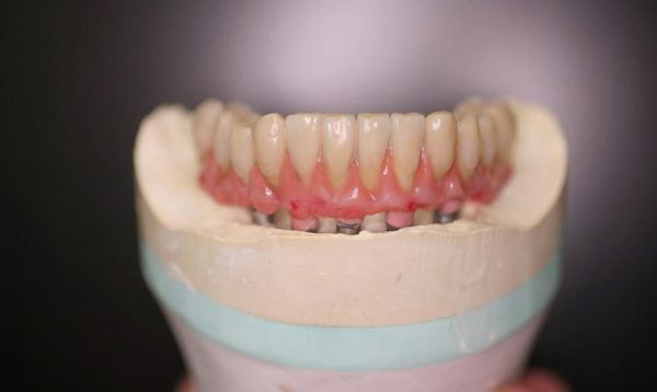 Lower full-arch implant bridge on its model in our lab