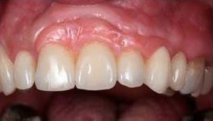 Upper implant bridge fitted