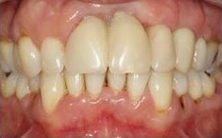 Upper front teeth before treatment
