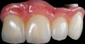 Upper implant bridge with gum-coloured porcelain, made in our lab
