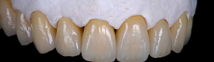 Upper porcelain crowns on a stone model, made in our lab