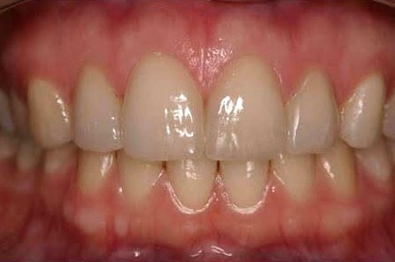 After: two porcelain veneers on the upper front teeth, teeth and lips only