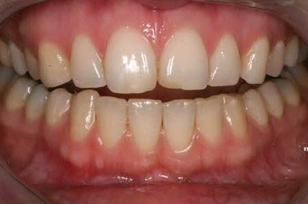 Before: upper front teeth, teeth and lips only