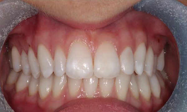 After teeth whitening, teeth and lips only