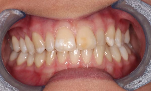 Before teeth whitening, teeth and lips only