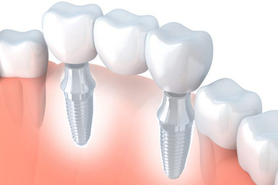 Dental Implants Gloucestershire