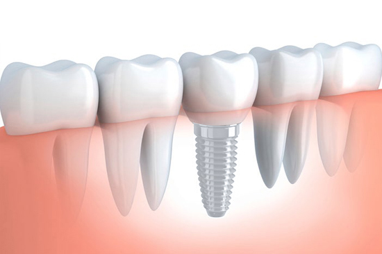 Dental Implants Gloucestershire ICDS