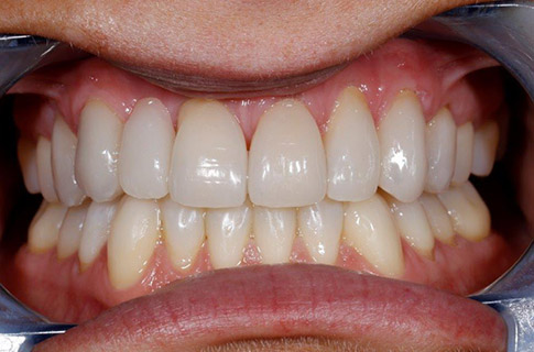 smile makeover after dentist-near-you-implant-ceramic-dental-studios