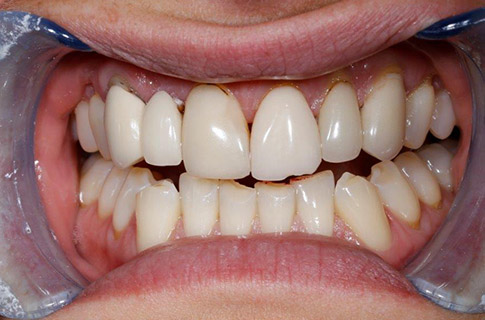 dentist-near-you-implant-ceramic-dental-studios