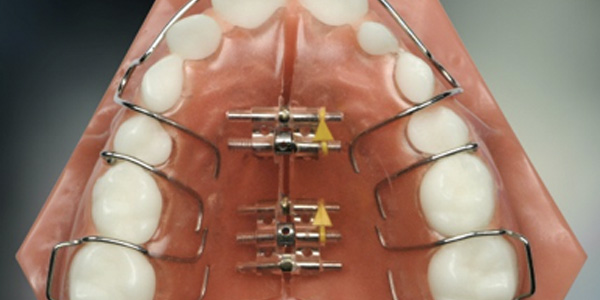 bone expander narrow arch no space overcrowding Dentist Miserden near me