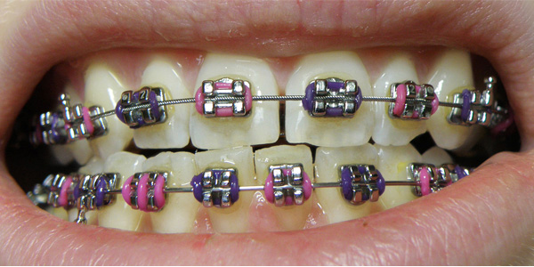 braces colourful straight teeth dentist miserden