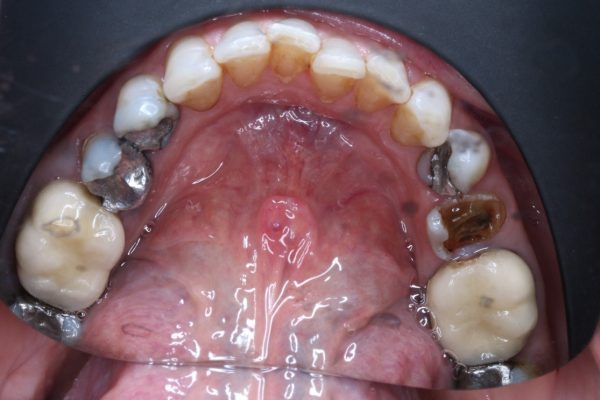 Safe Amalgam Removal Toxins Mercury Dentist Miserden