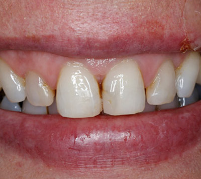 before make over dentist Gloucestershire Miserden Cotswold Case Study