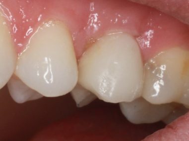all ceramic implant crown Dentist Gloucestershire gum line healing