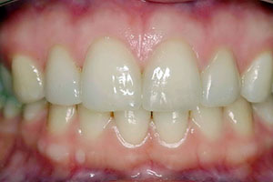 all new crowns colour match all ceramic